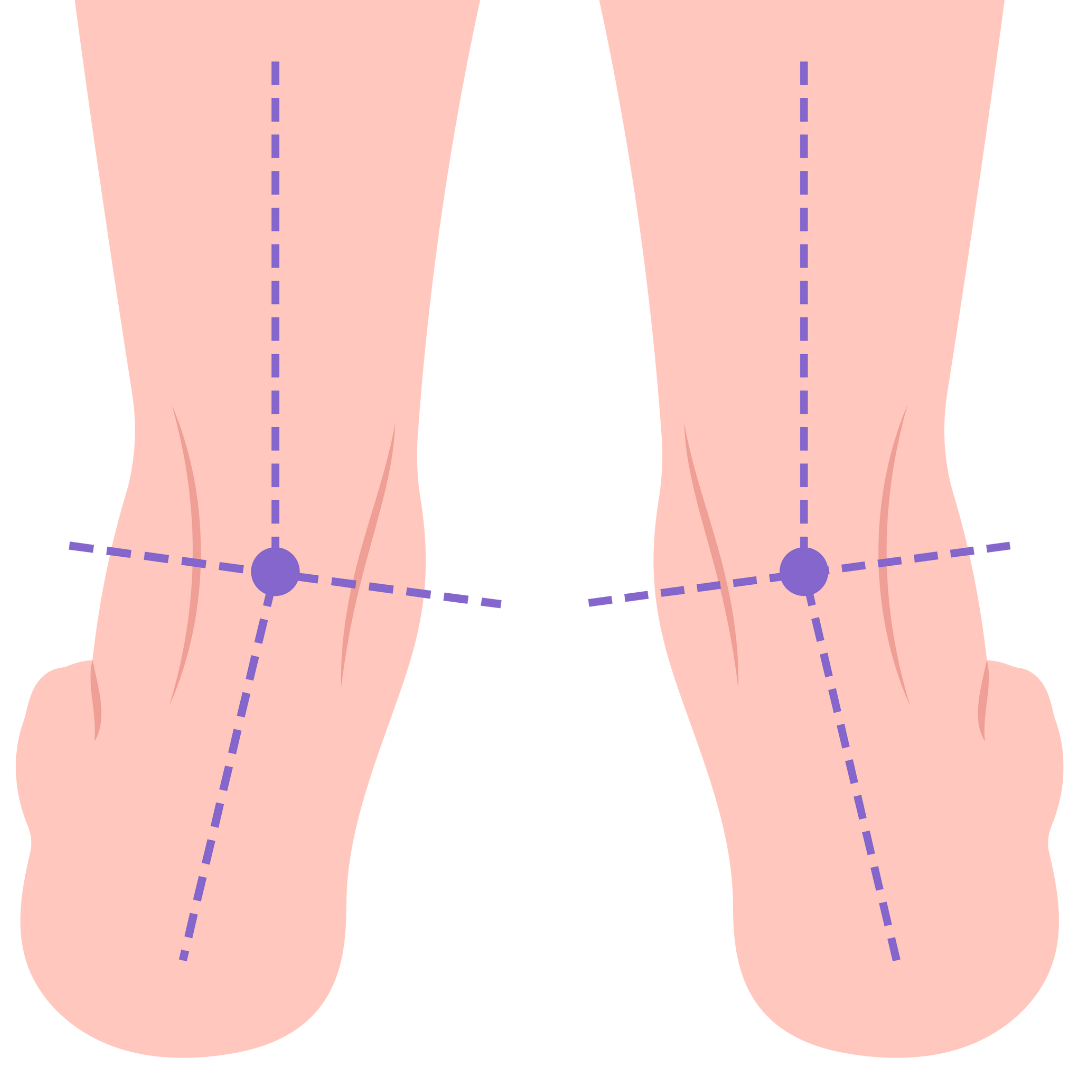 Überpronation
